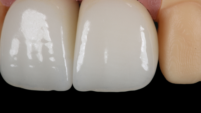 Computer 3D rendered anterior implant crowns of three teeth up-close with gums.