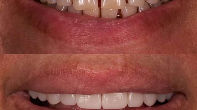 A before and after of a set of teeth. The before features teeth with gaps, while the after as whiter and even teeth.