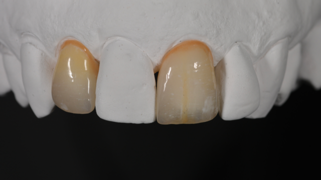 A mould of teeth with tooth crowns on it.