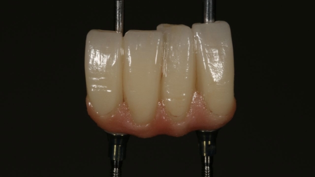 An implant anterior bridge.