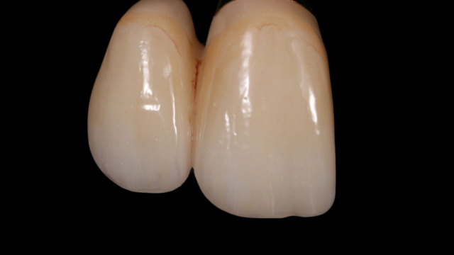A set of two teeth implant crowns.