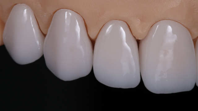 A 3D render of veneers.