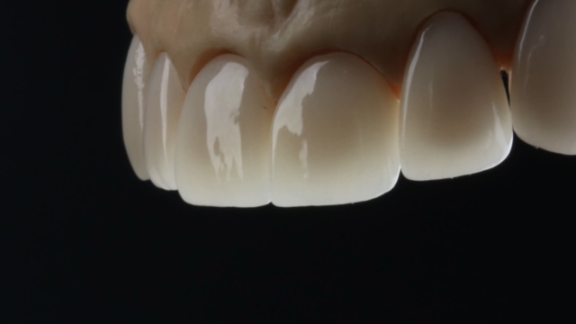 A 3D render of a set of veneers with gums.