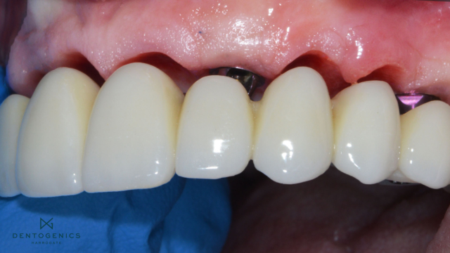 A top set of white teeth detaching from red gums.