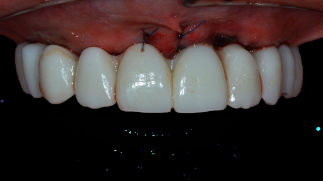 A top set of teeth surgically sewn on to the top of the gums inside a patient's mouth.