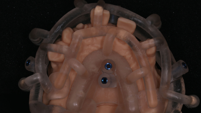 A transparent surgical guide placed over a model of teeth.