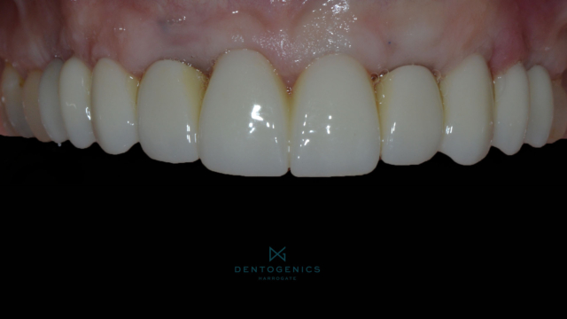 Upper full set of white teeth and gums.