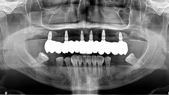 An x-ray of someone's jaw showing their top set of teeth as implants.
